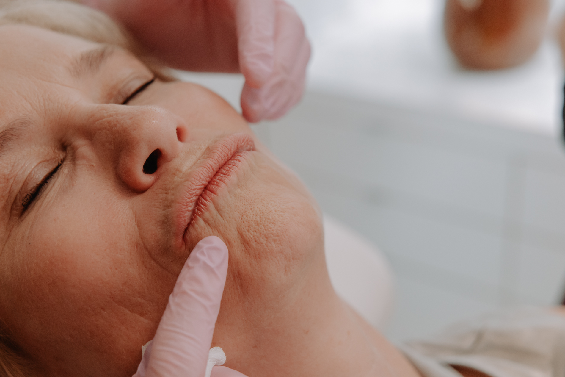 Erbium Laser - Deep resurfacing