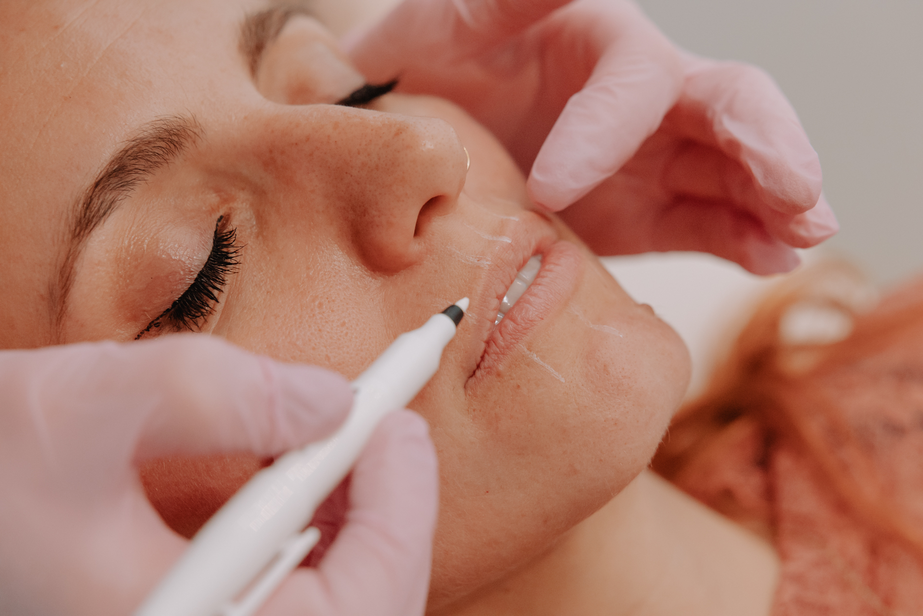 Behandeling lipfillers bij Skinject Clinic in Waasmunster