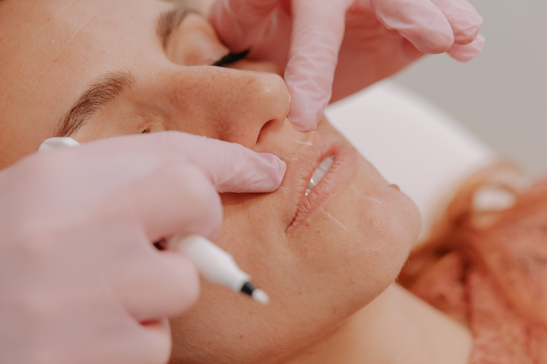 Behandeling lipflip met botox bij Skinject Clinic in Waasmunster