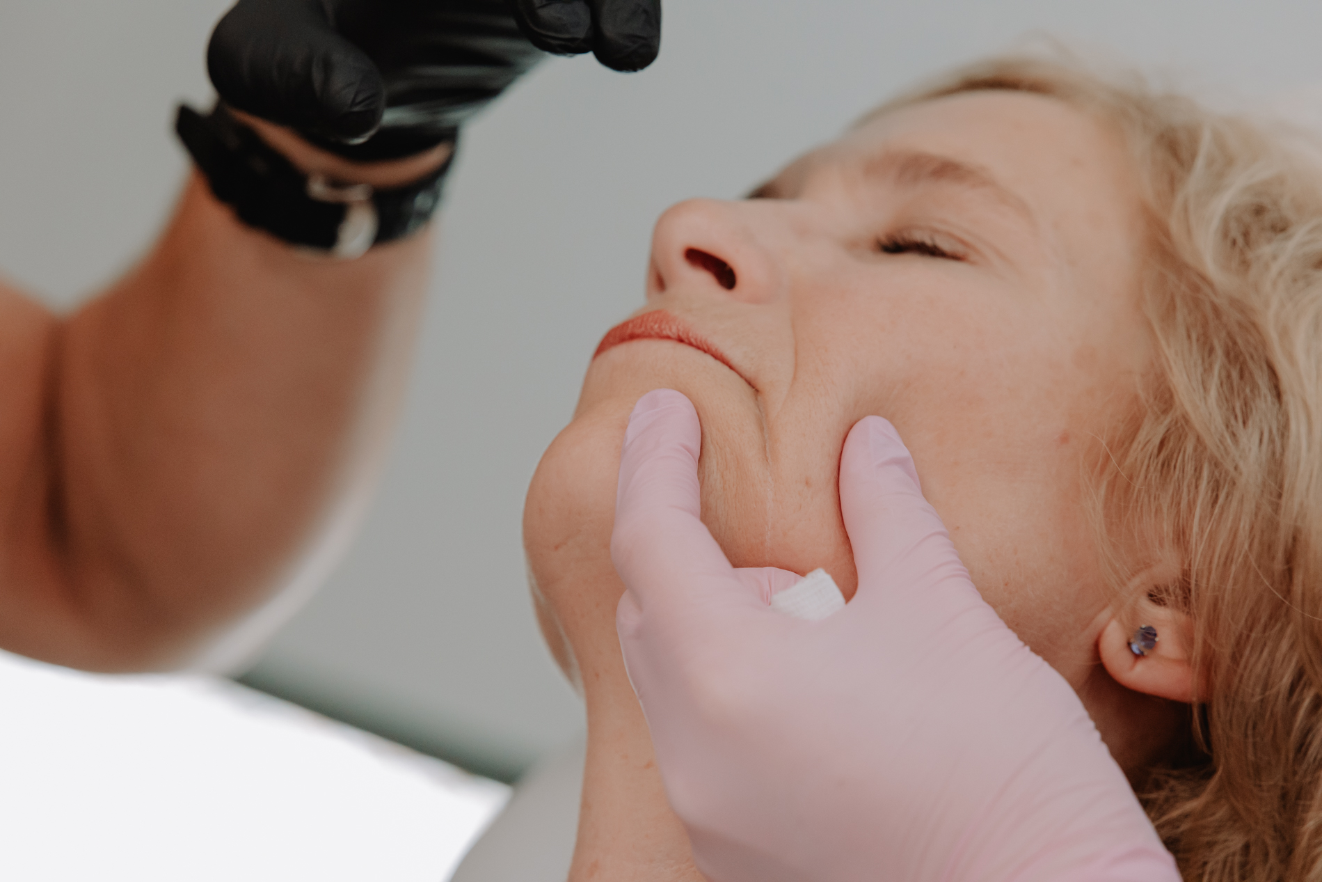 Filler – herstel van ondersteuning en verzachting van diepe plooien