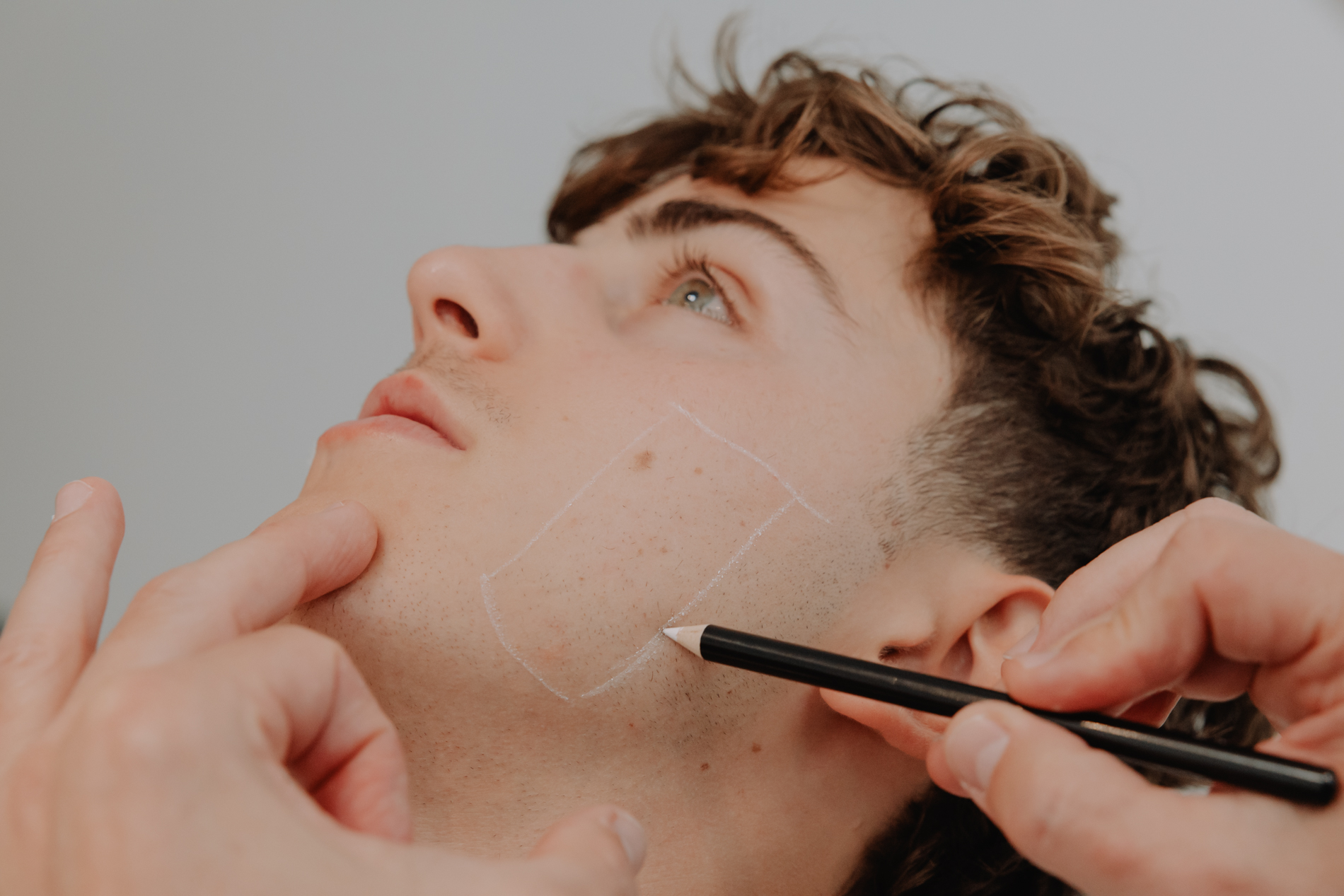 Acné en acnélittekens