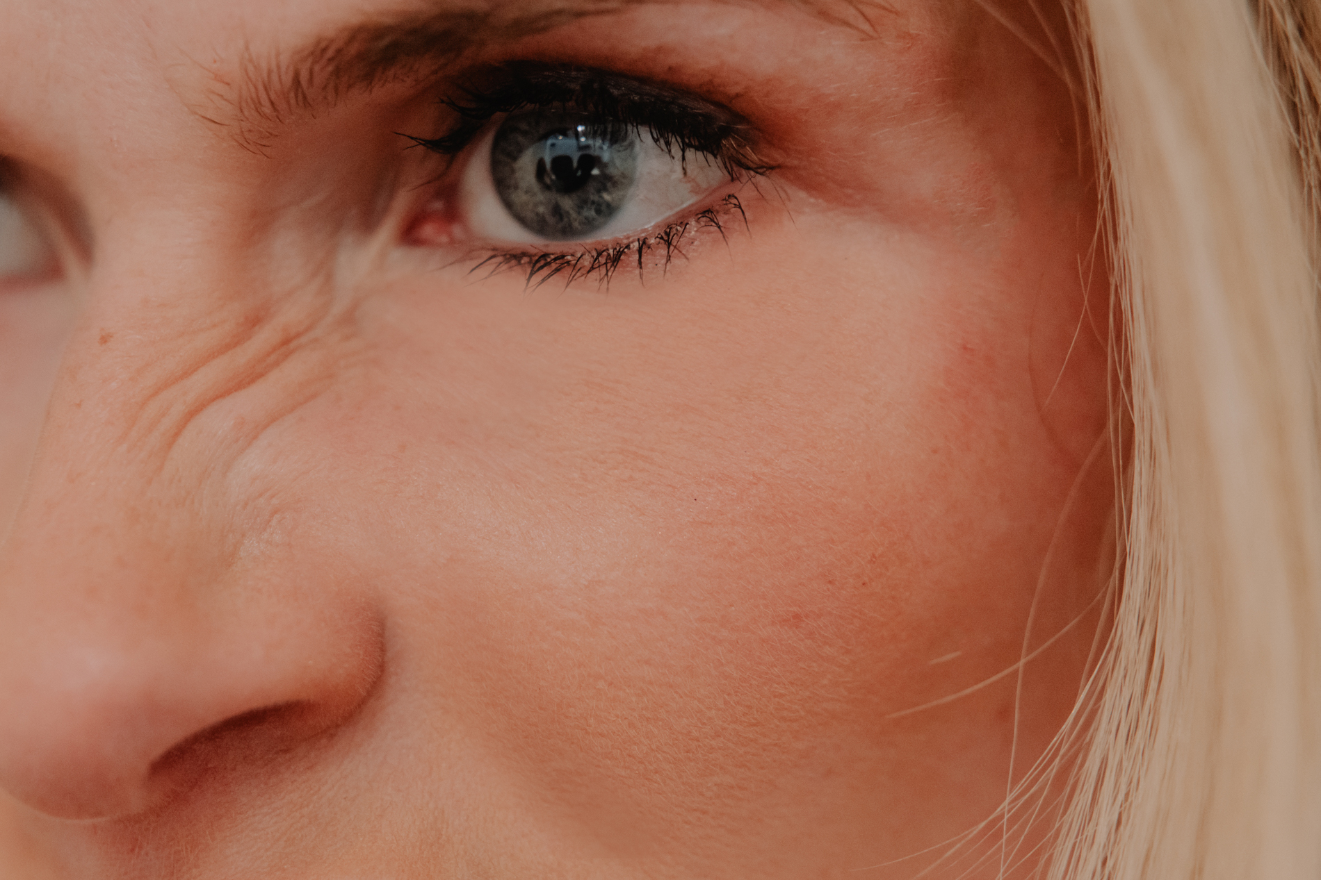 Neusrimpels (bunny lines)