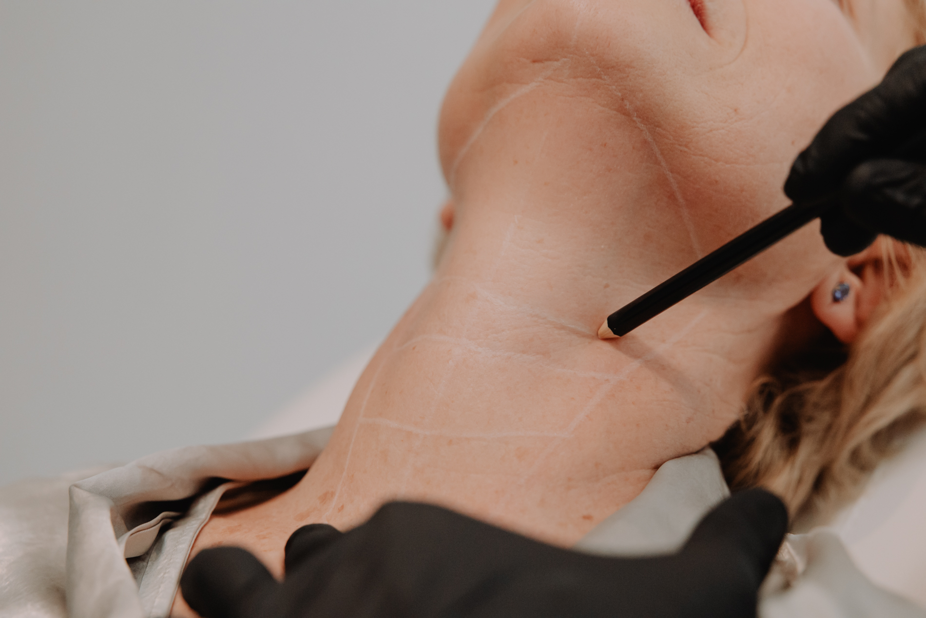 Verouderde huid in de hals en decolleté